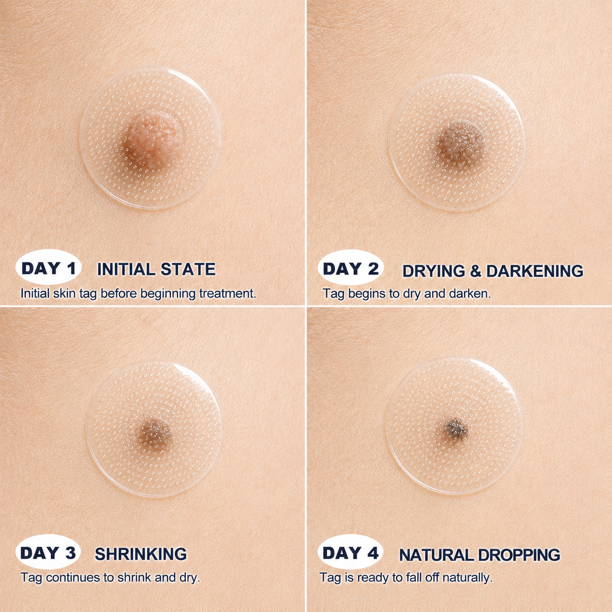 🚩TopSpire®🔥🐟Advanced Microneedle Skin Tag Removal Patch for Fast, Visible Results